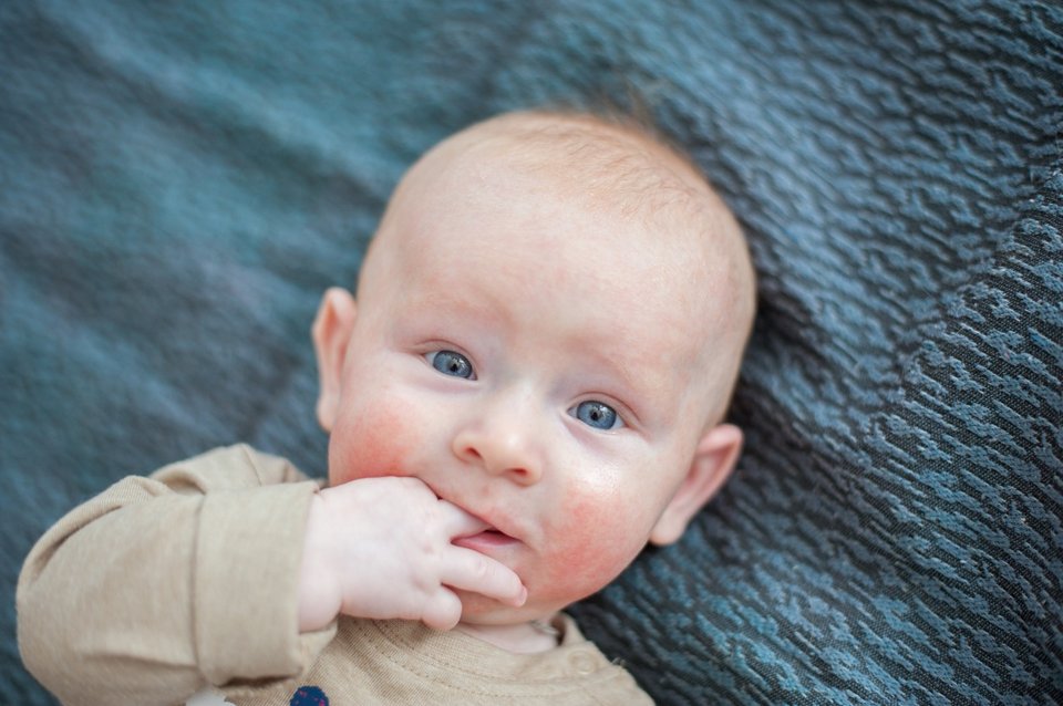 Baby Säugling Haut Neurodermitis trockene Haut