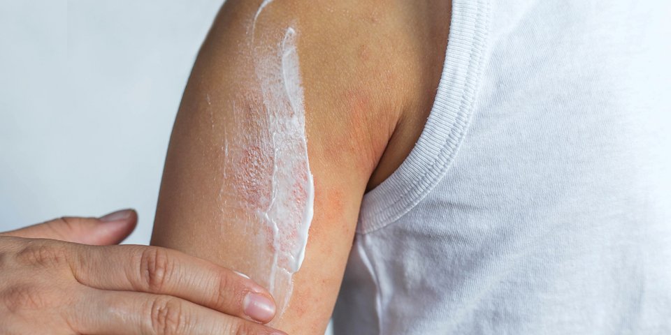 Neurodermitis Haut Creme trocken