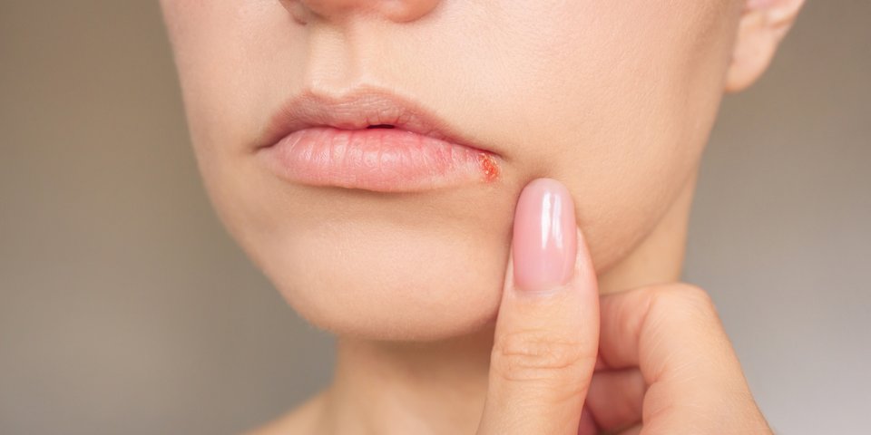 Frau mit Herpes an der Lippe