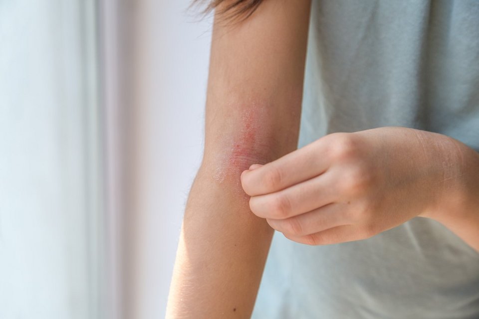 Juckreiz Haut Neurodermitis Arm Frau