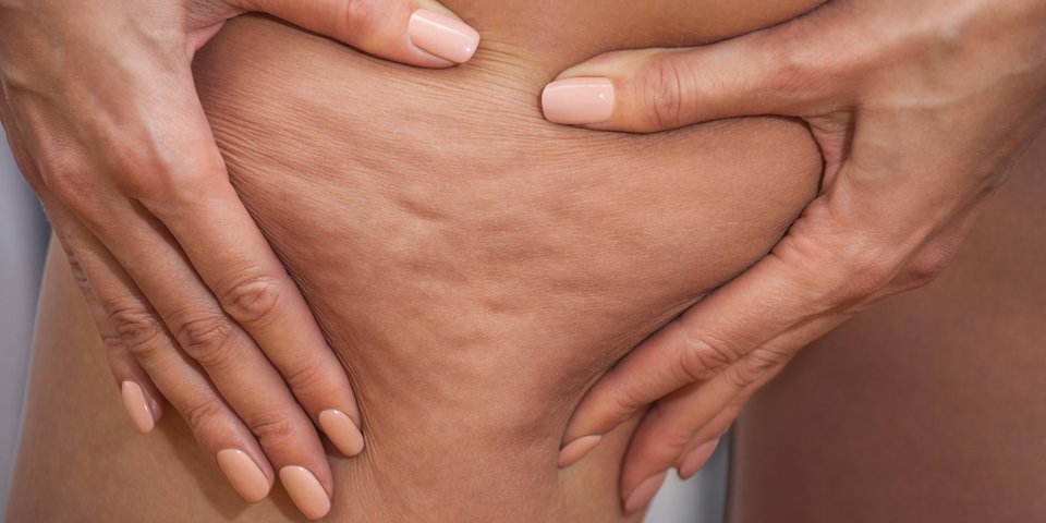 Cellulite Bindegewebe Haut
