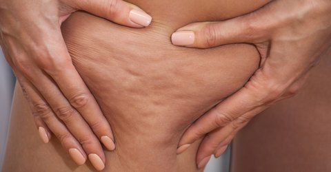 Cellulite Bindegewebe Haut